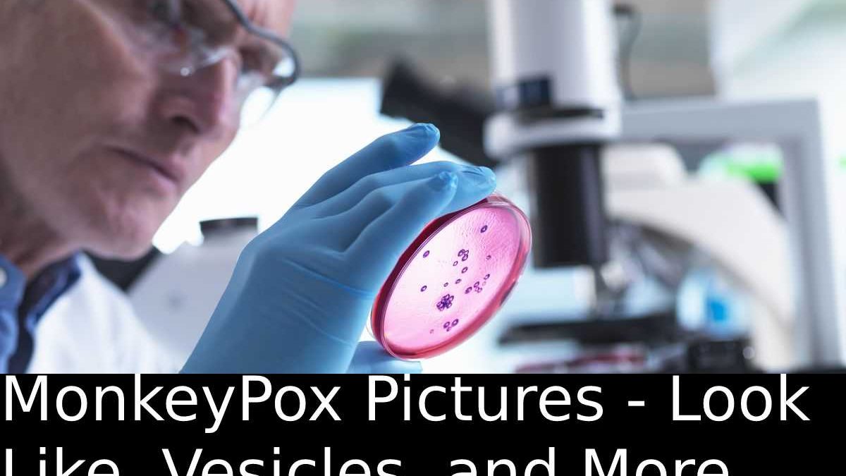 MonkeyPox Pictures – Look Like, Vesicles, and More